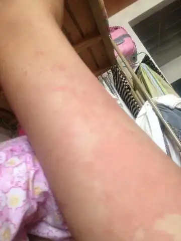 展开全部 荨麻疹会很容易反复发作,家里有螨虫,外面的粉尘,或者接触