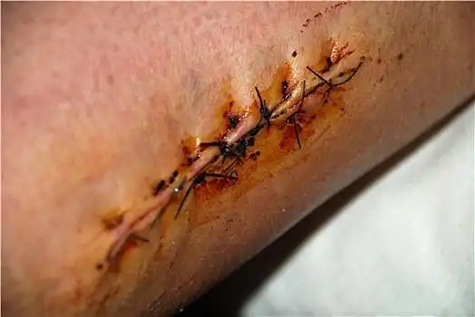 伤口图片_伤口图片大全_伤口图片下载_全景图库