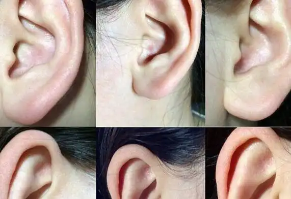 也就是说略微朝前生长的方向,那么这就是垂珠朝口的耳朵面相