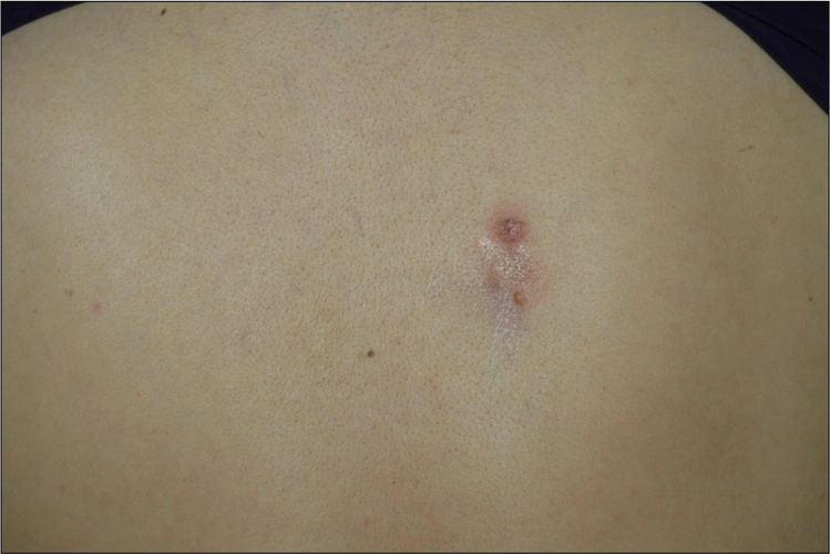 隆突性皮肤纤维肉瘤是什么?会危及生命吗? - 孕育宝典-试管之家