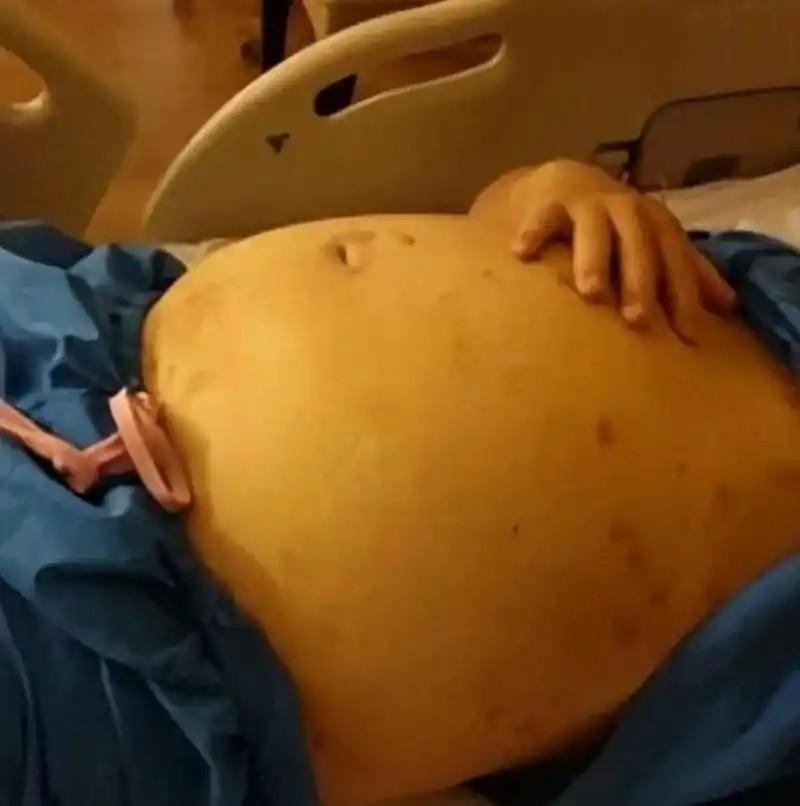 山东一男孩被同事以高压枪塞入肛门充气,肚子鼓得非常大,肚皮上的血管