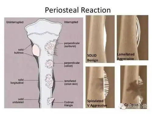 注意| 骨膜反应也需要分型