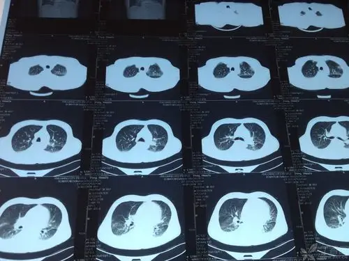 【病例讨论】发热咳嗽咳痰,肺部阴影 [病例帖]