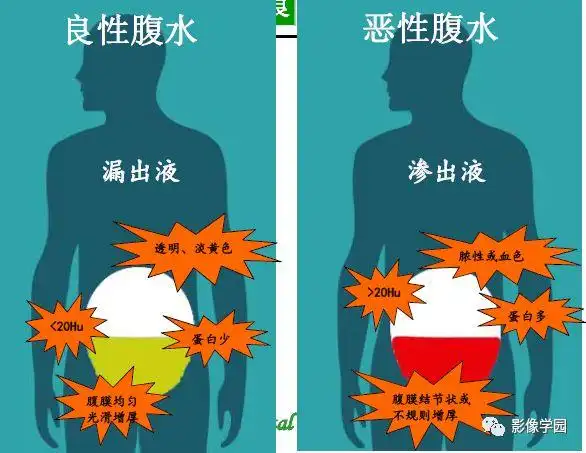 腹腔积液的良恶性表现与鉴别