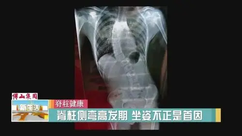 警惕儿童脊柱侧弯医生不正确坐姿是元凶