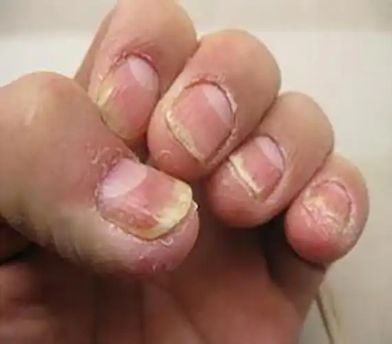 手指甲癣的症状和图片