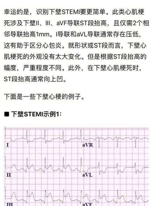 明显的st段抬高,其治疗类似于stemi)包括:v1至v4导联st段压低(非抬高)