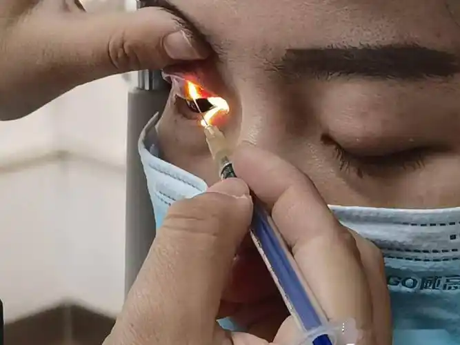 武汉普瑞眼科医院张晓农院长温馨提醒:眼结石的发病原因目前不明,但