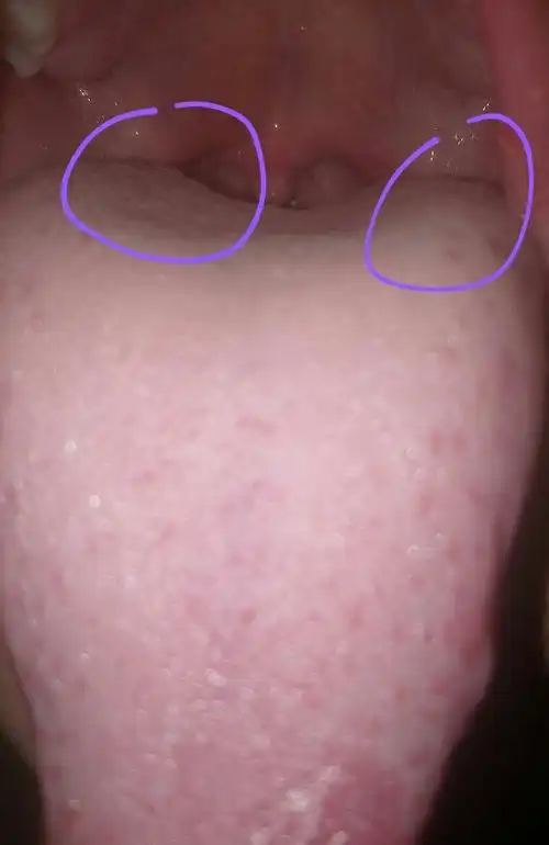 舌头里面的两边有白色的坨坨是什么?有45年了吧