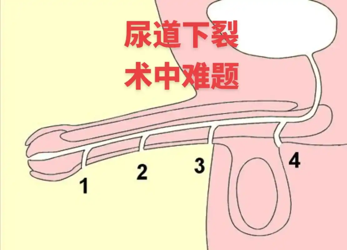 尿道下裂术中可能难题有哪些?