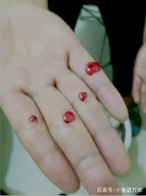 刺血疗法四缝穴的妙用