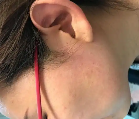 春季护肤要当心别让桃花癣毁了你的桃花运