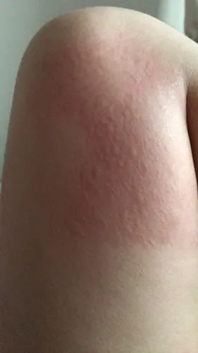 2条回答  你有碰到毛毛虫什么之类的么?