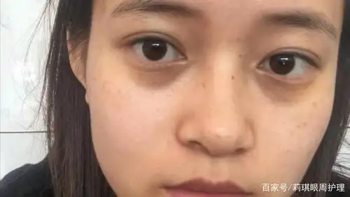 想知道我是怎么去黑眼圈的吗《莉琪》