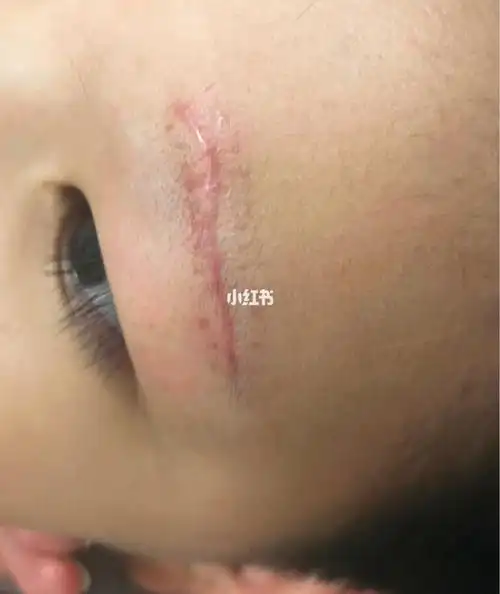 儿童疤痕day35