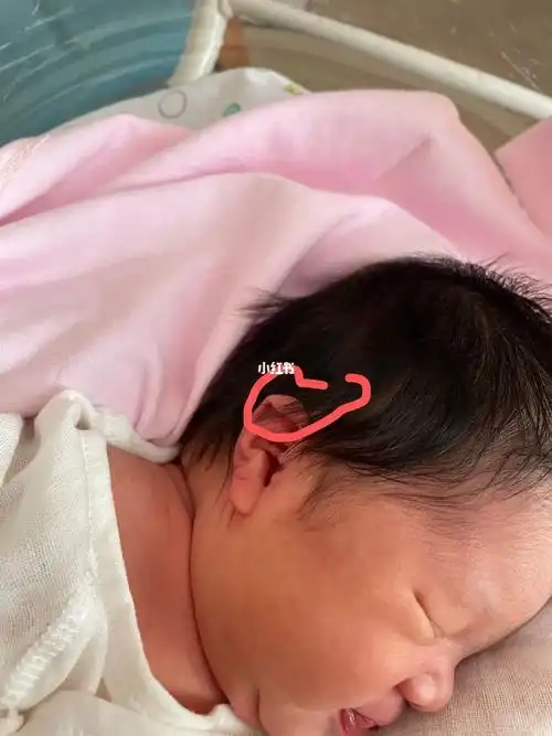 新生儿耳廓形态畸形,垂耳,矫正全过程!