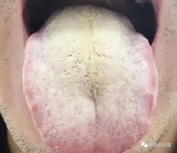 (舌苔黄腻)这种情况食补可以吃湿热方,如舌头两侧有齿痕,脾虚的情况可