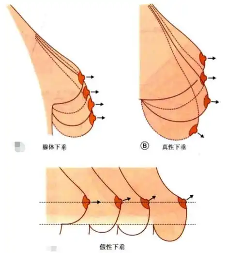 手术,比较受欢迎的有人工韧带提升,双环悬吊术,那么乳房下垂做人工