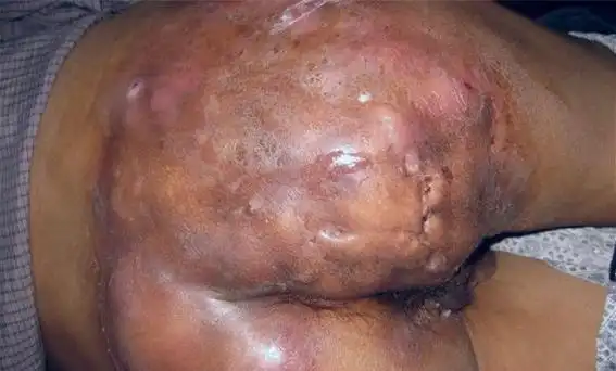 肛肠少见病图谱--肛周化脓性汗腺炎