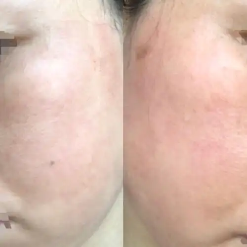 点阵激光治疗红斑消退时间