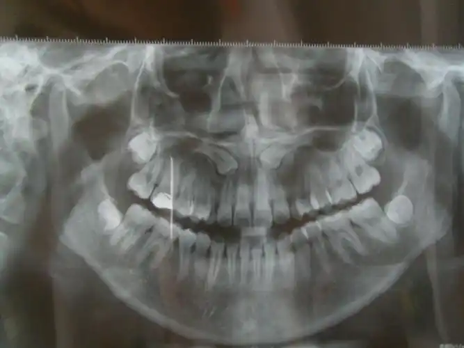 解决一下这种情况牙的问题 有ct片