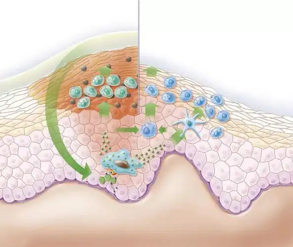 让人闻风丧胆的尖锐湿疣其实假性的根本不用治