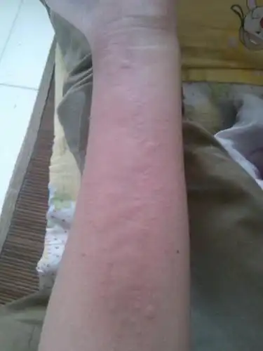 荨麻疹最快治疗方法小偏方3个