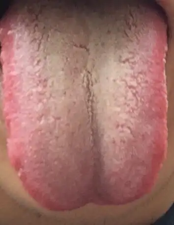 舌苔白厚什么情况啊