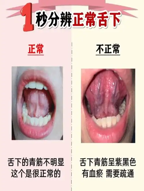 1秒分辨正常舌下