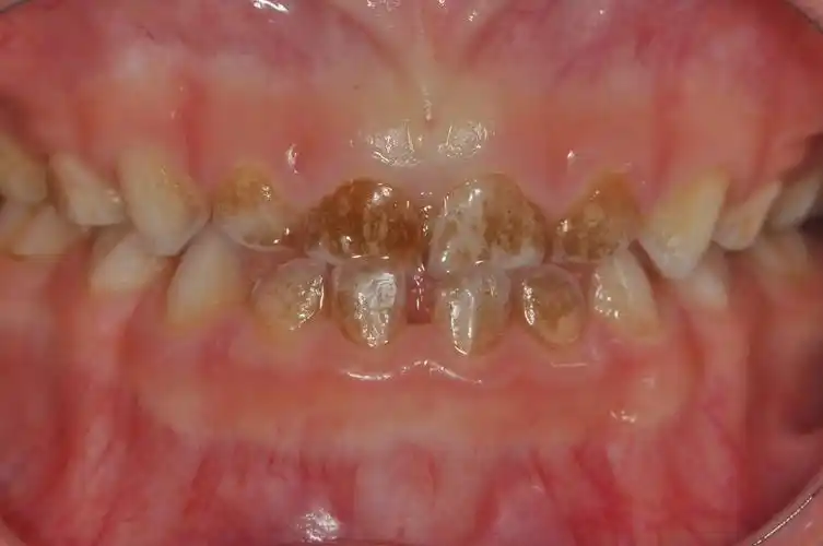 宝宝牙齿上有黑是什么情况