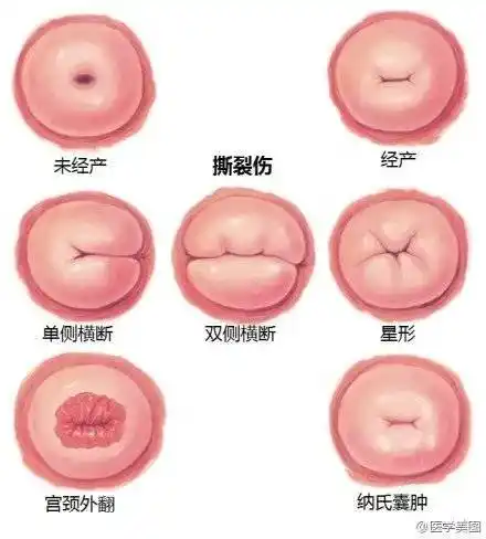 14,产后腹直肌分离:受妊娠期子宫张力影响,部分腹直肌纤维断裂,导致不