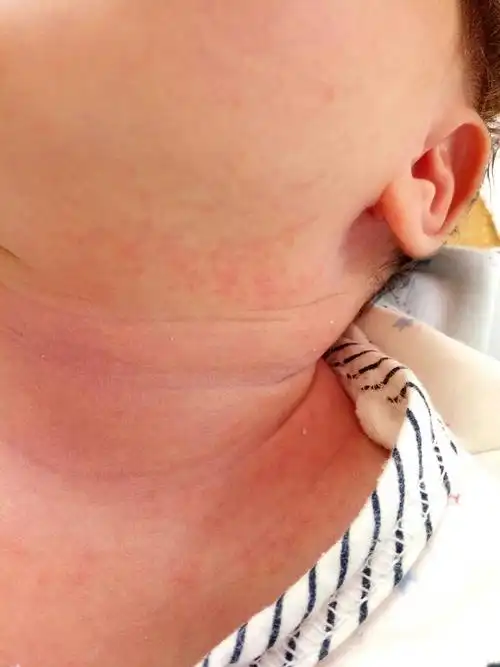 宝妈们帮帮忙,初生半月宝宝脖子上长了好多像热痱的东西