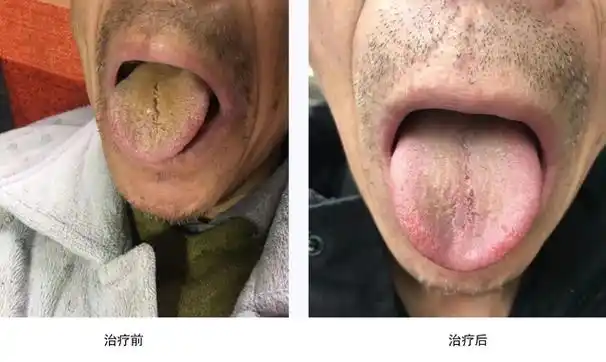 大爷胃癌发作腹痛难忍,中医出手受好评