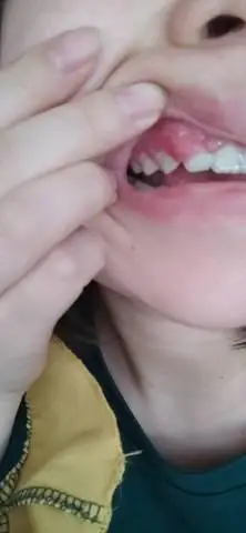 怀孕六个月了,牙龈肿的厉害 今天起来还有点疼 咋办呀 怎样快速解决它