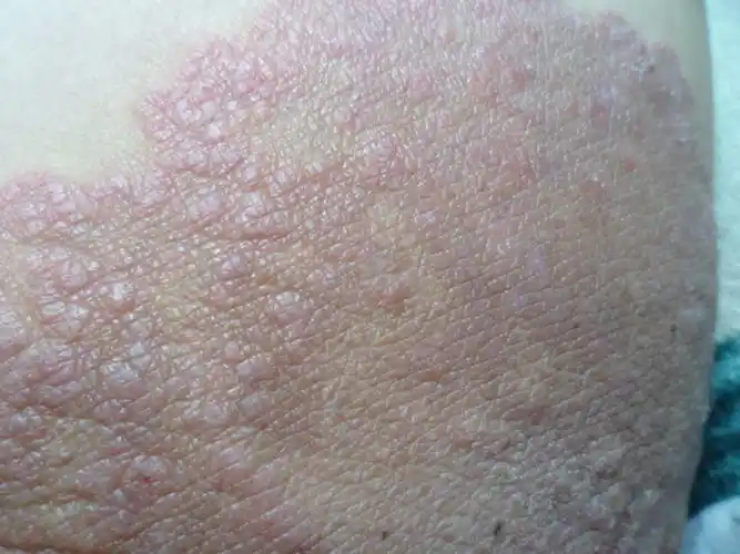 刺痒这是什么皮肤病,起因是阴囊总是潮湿,醋酸曲尿素乳膏和炉甘石洗剂