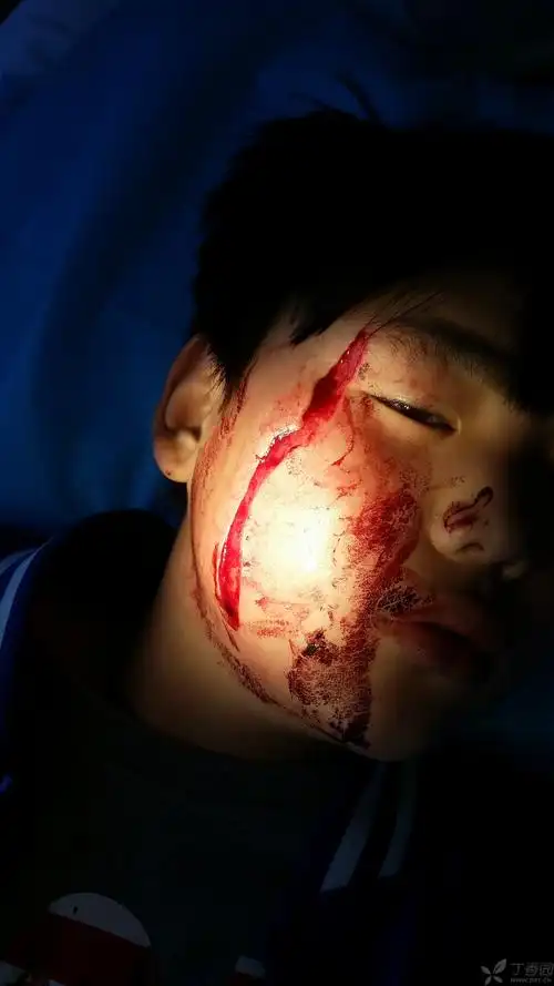 【讨论】面部外伤美容缝合 [病例帖]