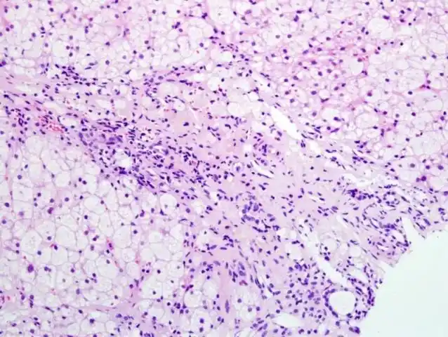 肝海蓝组织细胞增多症1例