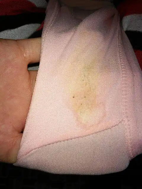 我就今天晚上测的 追答: 晨尿测比较好,或者看下蒙氏结节也可以判断