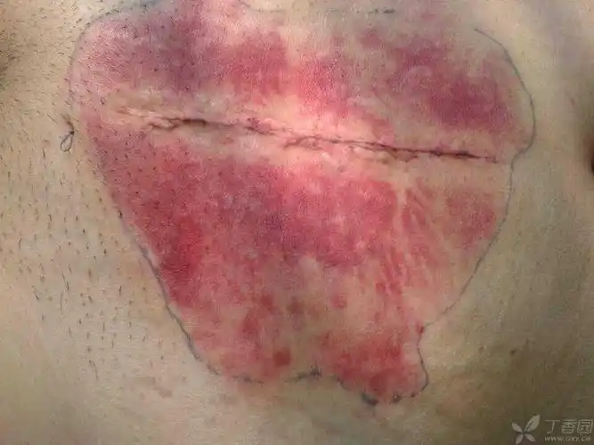 【请教】子宫全切术后第二天切口