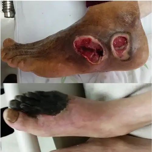 下肢动脉硬化闭塞症的临床表现和目前的治疗方法_动脉硬化闭塞症_发病