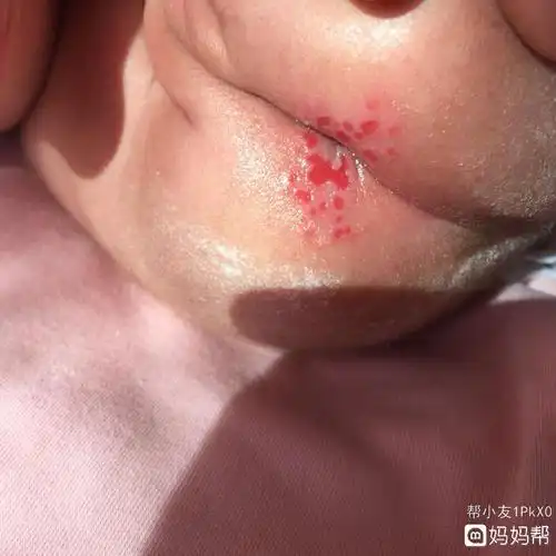 屁股上的疹子怎么办 屁股上的疹子怎么办图片