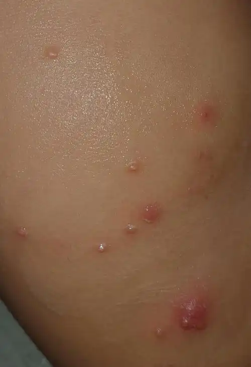 28个月宝宝改善传染性软疣的经历分享