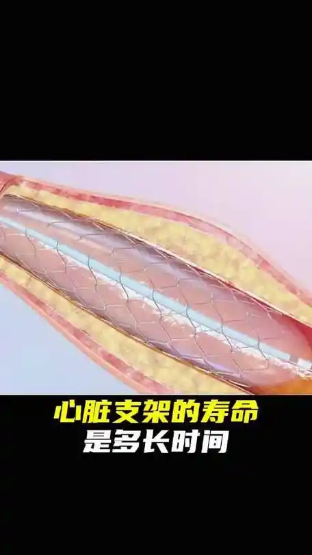 心脏支架的使用寿命是多久呢676767