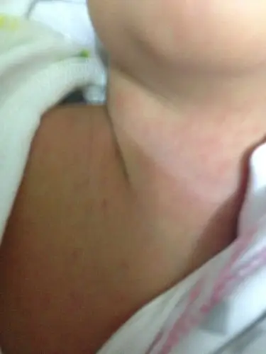 刚出生8天的宝宝,怕冷到她都果着就脖子和胸前面有,正常吗?