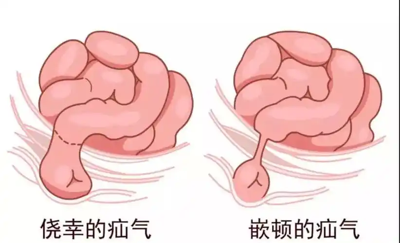 青海东大肛肠医院疝气有哪些症状五大症状不可不知