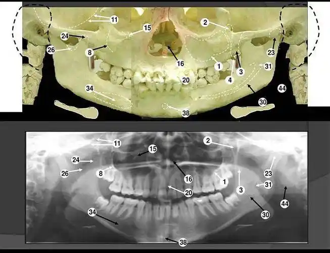 口腔内牙齿情况进行牙椅看诊医生对全景片进行分析和判断免费拍取全景
