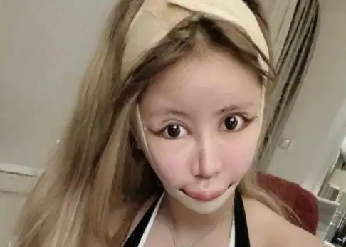 13岁开始整容前后花费100万看到整容后照片网友当场去世