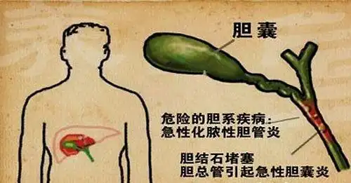 肝内胆管结石的病因多种多样最主要的还是这几种警惕
