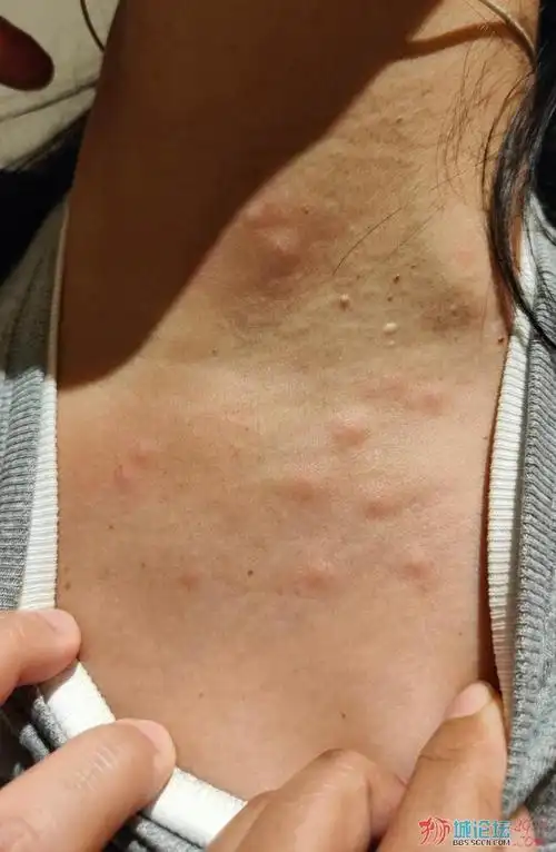 新加坡stsignature酒店对被臭虫咬伤顾客全额退款