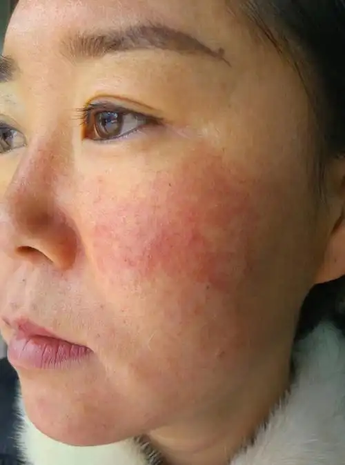 红血丝如何根除